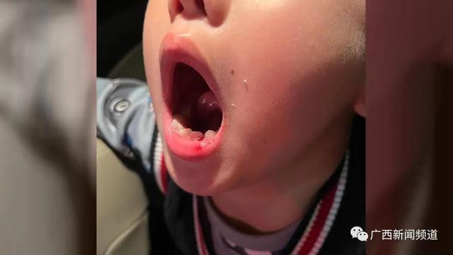 6岁男童被钢琴老师扇掉一颗牙 家长:经常骂学生对学生态度很凶